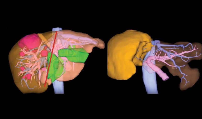 Johns Hopkins Surgeons Pioneer Combination of Procedures for Patients with Advanced Colorectal Cancer