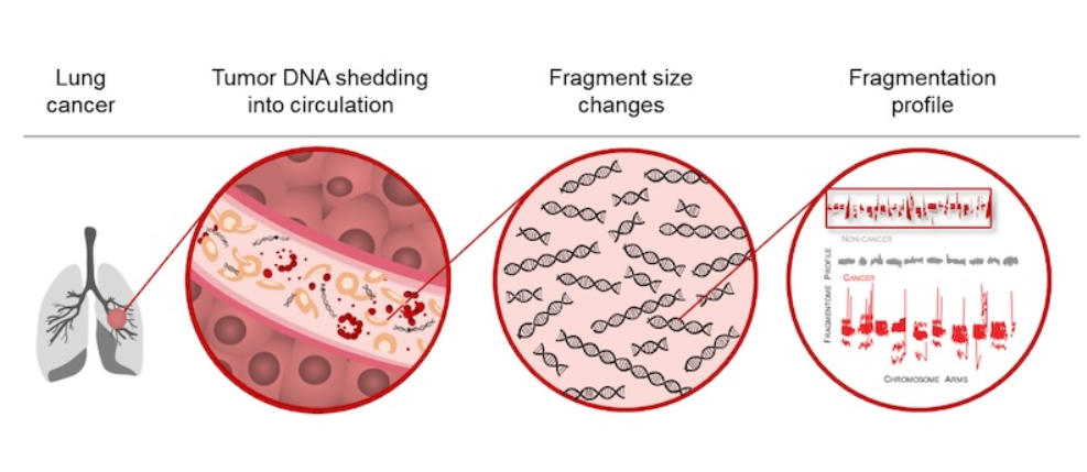 Artificial Intelligence Blood Test Provides a Reliable Way to Identify Lung Cancer