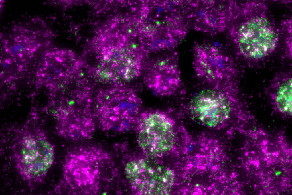 UV Radiation Damage Leads to Ribosome Roadblocks, Causing Early Skin Cell Death