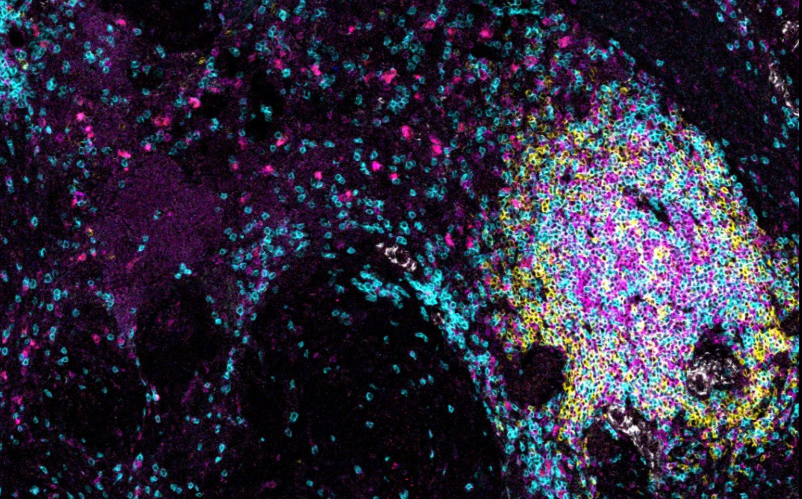 Lymph Node-Like Structures May Trigger the Demise of Cancer Tumors