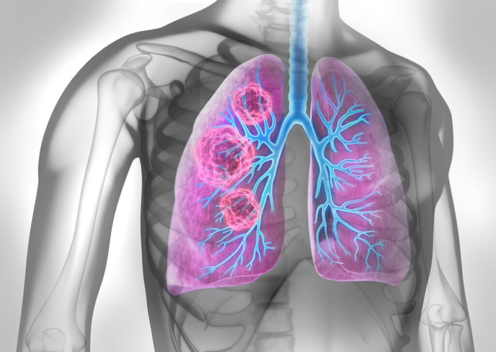 Immunotherapy Before and After Lung Cancer Surgery Reduces Death Risk, Disease Recurrence