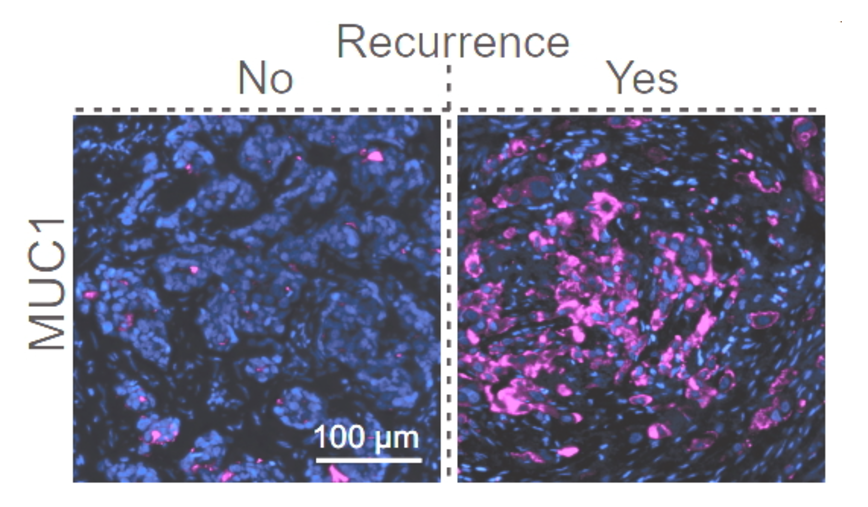 How Hypoxia Helps Cancer Spread