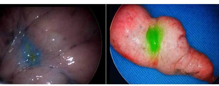 Fluorescent Imaging Breakthrough Helps Johns Hopkins Surgeons Target Hidden Lung Tumors