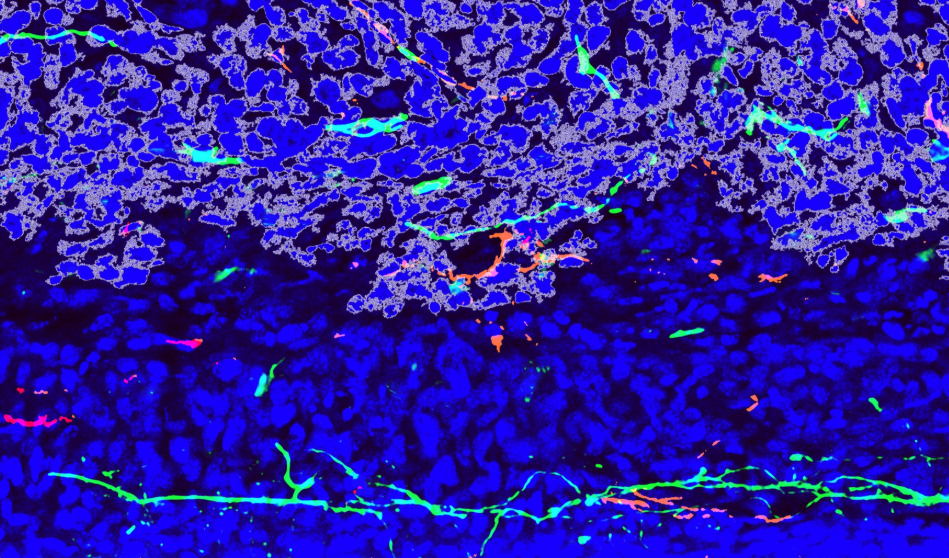 Johns Hopkins-Led Study Finds Drugs Approved for Treating Pain Also Reduce Bone Cancer Growth