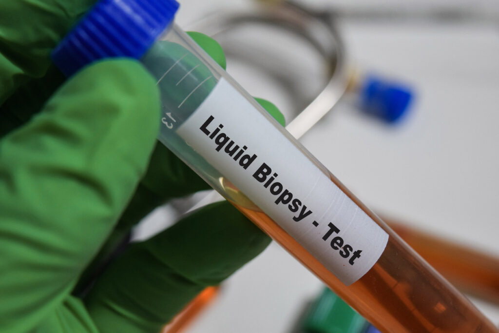 Detecting Early-Stage Cancers with a New Blood Test Measuring Epigenetic Instability