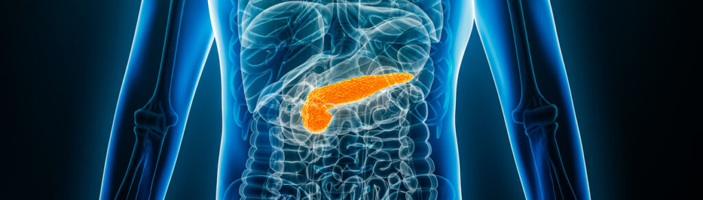 Extra Copies of Chromosome 1q May Drive Pancreatic Cancer